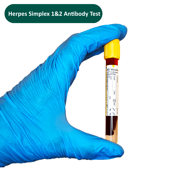 herpes-simplex-antibody-test depicted by gloved hand holding a blood tube